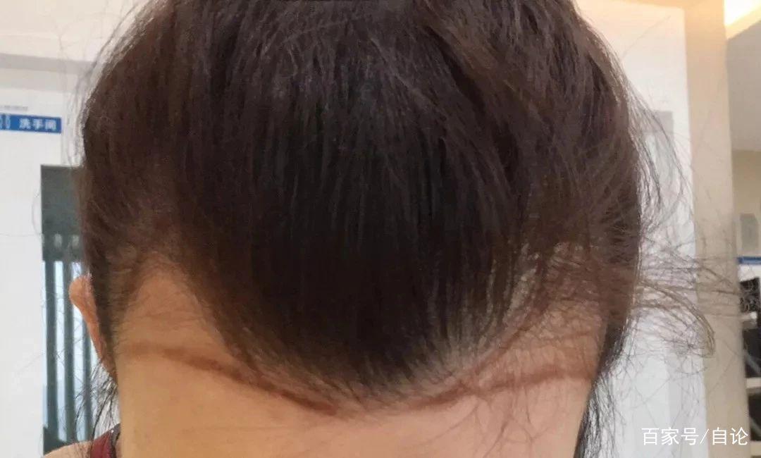 关于脱发与再生，十六岁的青春困惑，青春脱发与再生之谜，十六岁的头发故事