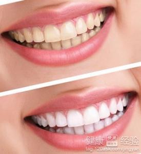 美白牙齿，打造灿烂笑容的关键步骤，美白牙齿，灿烂笑容的秘诀与关键步骤